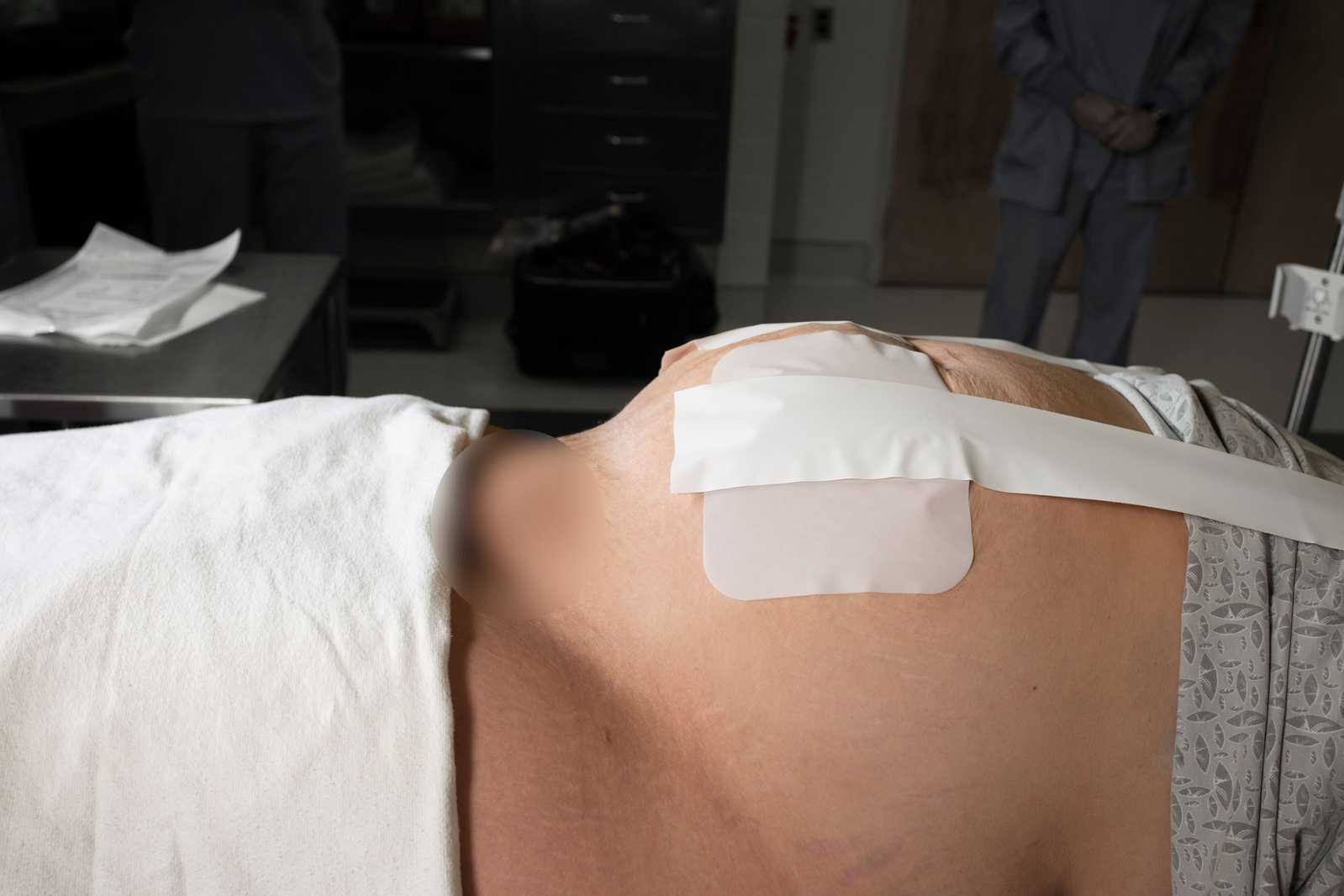 Pannus Retention System